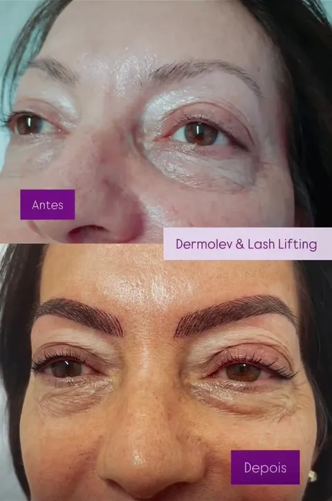 Antes e depois de Dermolev com lash lifting