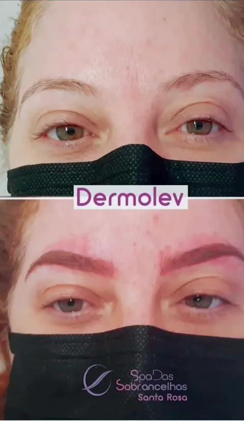 Antes e depois de sobrancelhas com Dermolev